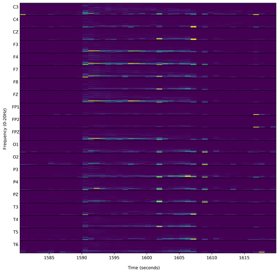 Automatic Detection of Epileptiform Discharges in Extra-cranial Electroencephalography